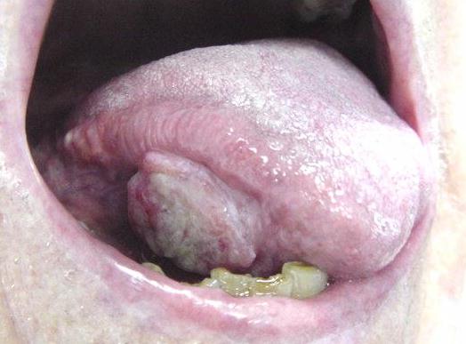 32 yr old chronic smoker with tongue cancer